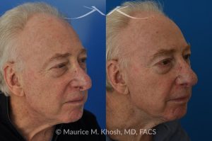 Photo of a patient before and after a procedure. Revision Rhinoplasty with Nasal Vestibular Stenosis Repair - This 73 year old had previously undergone rhinoplasty in his 20's. The surgery had left his nose deformed and severely obstructed. Revision rhinoplasty and repair of nasal vestibular stenosis was accomplished with use of cadaver rib cartilage. Revision surgery helped to restore a natural shape to the nose, and alleviate his breathing issues. He is delighted with the surgical results.