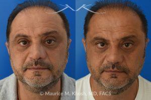 Photo of a patient before and after a procedure. Revision Rhinoplasty and Nasal Valve Reconstruction - This 53 year old had originally undergone rhinoplasty over 30 years ago. Surgery had left his nose pinched, depressed, short, and deformed. He had severe nasal obstruction. Revision rhinoplasty was performed with the use of his own rib cartilage to restore a normal shape to his nose and improve his breathing.