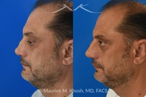 Photo of a patient before and after a procedure. Revision Rhinoplasty and Nasal Valve Reconstruction - This 53 year old had originally undergone rhinoplasty over 30 years ago. Surgery had left his nose pinched, depressed, short, and deformed. He had severe nasal obstruction. Revision rhinoplasty was performed with the use of his own rib cartilage to restore a normal shape to his nose and improve his breathing.