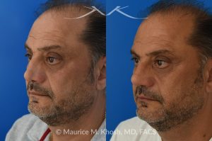 Photo of a patient before and after a procedure. Revision Rhinoplasty and Nasal Valve Reconstruction - This 53 year old had originally undergone rhinoplasty over 30 years ago. Surgery had left his nose pinched, depressed, short, and deformed. He had severe nasal obstruction. Revision rhinoplasty was performed with the use of his own rib cartilage to restore a normal shape to his nose and improve his breathing.