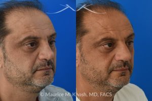Photo of a patient before and after a procedure. Revision Rhinoplasty and Nasal Valve Reconstruction - This 53 year old had originally undergone rhinoplasty over 30 years ago. Surgery had left his nose pinched, depressed, short, and deformed. He had severe nasal obstruction. Revision rhinoplasty was performed with the use of his own rib cartilage to restore a normal shape to his nose and improve his breathing.