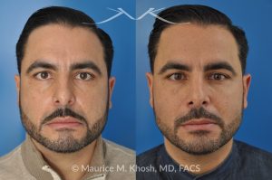 Photo of a patient before and after a procedure. Rhinoplasty for Subtle Reduction of the Dorsal Hump and Tip Elevation - before-and-after composite photo.
