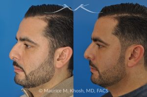 Photo of a patient before and after a procedure. Rhinoplasty for Subtle Reduction of the Dorsal Hump and Tip Elevation - before-and-after composite photo.