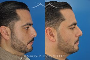 Photo of a patient before and after a procedure. Rhinoplasty for Subtle Reduction of the Dorsal Hump and Tip Elevation - before-and-after composite photo.