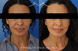 Photo of a patient before and after a procedure. Facelift for Natural Facial Rejuvenation and Lower Face Contouring - This delightful 57 year old desired a younger looking and natural enhancement of her face. Facelift surgery in New York was performed under local anesthesia as an office procedure. The before and after photos demonstrate her results 2 months after surgery. Notes the improved contour of the chin and jowls. The heavy-looking and squared appearing lower face has been transformed to a heart shaped lower face. The new and improved look is complementary and natural appearing. The patient is thrilled with her beautiful results. 
