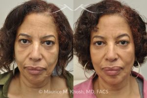 Photo of a patient before and after a procedure. Botox Injections for Frown Lines and Chin, Restylane Treatment for Cheeks and Marionette Lines - before and after photo.