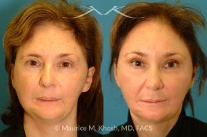Photo of a patient before and after a procedure. Brow Lift - before and after photo.