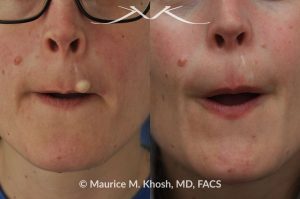 Photo of a patient before and after a procedure. Upper Lip Cyst Removal - This procedure involved the excision of a cyst from the upper lip, successfully removing the growth and improving the appearance of the affected area.
