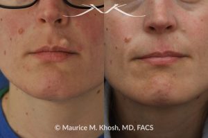 Photo of a patient before and after a procedure. Upper Lip Cyst Removal - This procedure involved the excision of a cyst from the upper lip, successfully removing the growth and improving the appearance of the affected area.