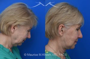 Photo of a patient before and after a procedure. Deep Plane Facelift with Brow and Eyelid Rejuvenation - Our delightful patient was interested in overall facial rejuvenation. She underwent lower blepharoplasty with orbital fat repositioning, temporal brow lift, and a deep plane facelift. She is ecstatic with her surgical results.