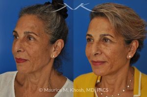 Photo of a patient before and after a procedure. Facelift and Neck Lift for Lower Face and Neck Rejuvenation - This delightful 68-year old underwent facelift and neck lift surgery to rejuvenate the lower face and neck area. The SMAS facelift allowed resolution of her jowls and sagging cheeks. The neck lift procedure helped to improve the sagging neck, and the skin hanging in the neck. She is ecstatic with the beautiful and natural results of her facelift and neck lift.