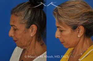 Photo of a patient before and after a procedure. Facelift and Neck Lift for Lower Face and Neck Rejuvenation - This delightful 68-year old underwent facelift and neck lift surgery to rejuvenate the lower face and neck area. The SMAS facelift allowed resolution of her jowls and sagging cheeks. The neck lift procedure helped to improve the sagging neck, and the skin hanging in the neck. She is ecstatic with the beautiful and natural results of her facelift and neck lift.