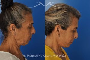 Photo of a patient before and after a procedure. Facelift and Neck Lift for Lower Face and Neck Rejuvenation - This delightful 68-year old underwent facelift and neck lift surgery to rejuvenate the lower face and neck area. The SMAS facelift allowed resolution of her jowls and sagging cheeks. The neck lift procedure helped to improve the sagging neck, and the skin hanging in the neck. She is ecstatic with the beautiful and natural results of her facelift and neck lift.