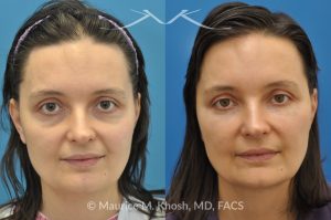 Photo of a patient before and after a procedure. Facial Rejuvenation with Fat Grafting - before and after photo.