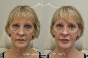 Photo of a patient before and after a procedure. Juvederm Facial Filler Injections for Cheeks, Lips, and Orbital Hollows - before and after photo.