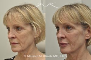 Photo of a patient before and after a procedure. Juvederm Facial Filler Injections for Cheeks, Lips, and Orbital Hollows - before and after photo.