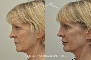 Photo of a patient before and after a procedure. Juvederm Facial Filler Injections for Cheeks, Lips, and Orbital Hollows - before and after photo.