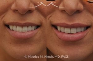 Photo of a patient before and after a procedure. Lip Augmentation with Hyaluronic Acid Filler - This 33-year-old young woman was interested in a beautiful and natural augmentation of her lips. She wanted more voluptuous and sexy lips without appearing puffy or over-done. Hyaluronic acid filler was used to give her a subtle but noticeable improvement.