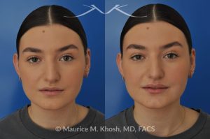 Photo of a patient before and after a procedure. Lip Augmentation with Volbella Filler for Symmetry and Volume - This young lady was interested in enhancing the appearance of her lips. She was  noted to have small calibered and asymmetric upper lip. A hyaluronic acid filler (Volbella) was used to augment the upper and lower lips. Precise placement of the filler not only created fuller lips, it also allowed creation of symmetry in the upper lip.