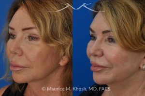 Photo of a patient before and after a procedure. Upper Lip Rejuvenation Surgery - This 65 year old desired a rejuvenated upper lip. She noted the upper lip to be excessively long, covering her upper teeth and giving her a tired and aged appearance. Lip fillers only exacerbated the problem. The post op photos on the right side show her results at 6 months after surgery.