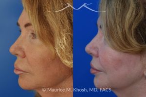 Photo of a patient before and after a procedure. Upper Lip Rejuvenation Surgery - This 65 year old desired a rejuvenated upper lip. She noted the upper lip to be excessively long, covering her upper teeth and giving her a tired and aged appearance. Lip fillers only exacerbated the problem. The post op photos on the right side show her results at 6 months after surgery.