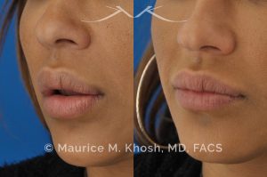 Photo of a patient before and after a procedure. Lip Reduction - Lip reduction to improve the swollen appearing upper lip, which was caused by Silocone injection of the lips