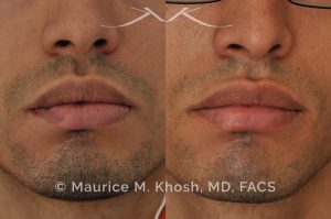 Photo of a patient before and after a procedure. Lip Scar Revision - Lip scar revision to improve a depressed scar in the right lower lip, near the corner.