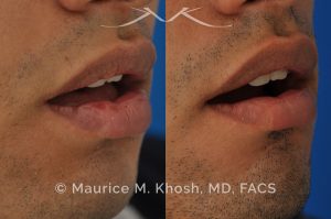 Photo of a patient before and after a procedure. Lip Scar Revision - Lip scar revision to improve a depressed scar in the right lower lip, near the corner.