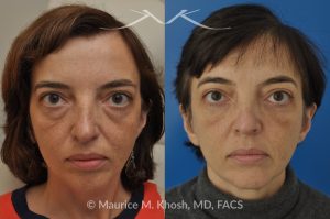 Photo of a patient before and after a procedure. Lower Eyelid Lift - Lower eyelid lift (lower blepharoplasty) performed through a trans-conjunctival incision to eliminate puffy bulges in the lower eyelid.