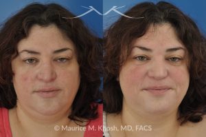 Photo of a patient before and after a procedure. Nasal Valve Repair with Rib Cartilage Graft - Nasal valve repair (repair of nasal vestibular stenosis) with rib cartilage graft.