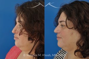 Photo of a patient before and after a procedure. Nasal Valve Repair with Rib Cartilage Graft - Nasal valve repair (repair of nasal vestibular stenosis) with rib cartilage graft.