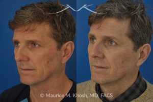 Photo of a patient before and after a procedure. Nasal Valve Repair with Cadaver Rib Cartilage - Repair of nasal vestibular stenosis using cadaver rib cartilage as spreader grafts to widen the internal nasal valve by Dr. Maurice Khosh.