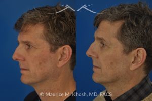 Photo of a patient before and after a procedure. Nasal Valve Repair with Cadaver Rib Cartilage - Repair of nasal vestibular stenosis using cadaver rib cartilage as spreader grafts to widen the internal nasal valve by Dr. Maurice Khosh.