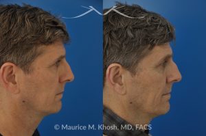 Photo of a patient before and after a procedure. Nasal Valve Repair with Cadaver Rib Cartilage - Repair of nasal vestibular stenosis using cadaver rib cartilage as spreader grafts to widen the internal nasal valve by Dr. Maurice Khosh.