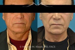 Photo of a patient before and after a procedure. Direct Neck Lift with Grecian Urn Technique - This 73 year old gentleman, with past facelift surgery, complained of central neck skin laxity and 'turkey wattles'. The neck skin and muscle was tightened with the Grecian Urn direct neck lift technique.