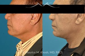 Photo of a patient before and after a procedure. Direct Neck Lift with Grecian Urn Technique - This 73 year old gentleman, with past facelift surgery, complained of central neck skin laxity and 'turkey wattles'. The neck skin and muscle was tightened with the Grecian Urn direct neck lift technique.