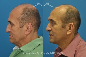 Photo of a patient before and after a procedure. Conservative SMAS Facelift with Neck Lift - 66 year old man who wanted tightening of neck skin and improvement in the jowls while maintaining a natural an un-operated look. A conservative SMAS facelift with simultaneous neck lift helped achieve his desired goals.