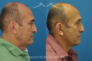 Photo of a patient before and after a procedure. Conservative SMAS Facelift with Neck Lift - 66 year old man who wanted tightening of neck skin and improvement in the jowls while maintaining a natural an un-operated look. A conservative SMAS facelift with simultaneous neck lift helped achieve his desired goals.