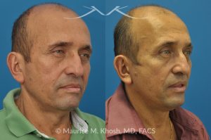 Photo of a patient before and after a procedure. Conservative SMAS Facelift with Neck Lift - 66 year old man who wanted tightening of neck skin and improvement in the jowls while maintaining a natural an un-operated look. A conservative SMAS facelift with simultaneous neck lift helped achieve his desired goals.