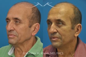 Photo of a patient before and after a procedure. Conservative SMAS Facelift with Neck Lift - 66 year old man who wanted tightening of neck skin and improvement in the jowls while maintaining a natural an un-operated look. A conservative SMAS facelift with simultaneous neck lift helped achieve his desired goals.