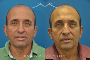 Photo of a patient before and after a procedure. Conservative SMAS Facelift with Neck Lift - 66 year old man who wanted tightening of neck skin and improvement in the jowls while maintaining a natural an un-operated look. A conservative SMAS facelift with simultaneous neck lift helped achieve his desired goals.