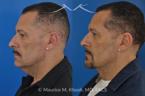 Photo of a patient before and after a procedure. Direct Neck Lift with Lipoma Removal - Necklift performed directly through a midline neck incision. Simultaneous removal of benign fatty tumor of the neck (lipoma) through the same approach
