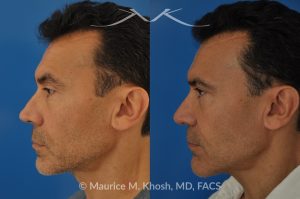 Photo of a patient before and after a procedure. Repair of Nasal Valve Obstruction with Revision Rhinoplasty - This gentleman had previously undergone two rhinoplasty operations over 15 years ago. His nasal tip was pinched and obstructing his breathing, Cadaver rib cartilage was used to strengthen and support his external nasal valve. The nasal tip was slightly elevated.