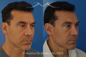 Photo of a patient before and after a procedure. Repair of Nasal Valve Obstruction with Revision Rhinoplasty - This gentleman had previously undergone two rhinoplasty operations over 15 years ago. His nasal tip was pinched and obstructing his breathing, Cadaver rib cartilage was used to strengthen and support his external nasal valve. The nasal tip was slightly elevated.