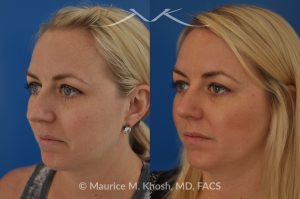 Photo of a patient before and after a procedure. Bilateral Nasal Valve Repair - Includes spreader grafts and tip rhinoplasty to improve nasal airflow and tip symmetry.