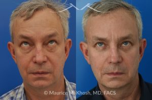 Photo of a patient before and after a procedure. Upper and Lower Blepharoplasty - This delightful 55 year old dislikes the puffy upper and lower eyelids which made him look tired and 'old'. He underwent upper and lower blepharoplasty in Manhattan. The excess skin and fat was removed from the upper eyelid through a perfectly hidden incision. The lower eyelid excess fat was removed from inside the eyelid, so as not to leave any scars.