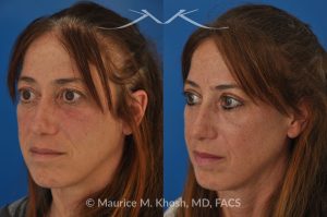 Photo of a patient before and after a procedure. Upper Eyelid Surgery to Remove Excess Skin - This 52 year-old lady was unhappy with droopy and puffy upper eyelids which prevented her from applying eye shadow. She underwent upper eyelid lift, upper blepharoplasty, to get rid of excess skin in the upper eyelid.