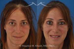 Photo of a patient before and after a procedure. Upper Eyelid Surgery to Remove Excess Skin - This 52 year-old lady was unhappy with droopy and puffy upper eyelids which prevented her from applying eye shadow. She underwent upper eyelid lift, upper blepharoplasty, to get rid of excess skin in the upper eyelid.