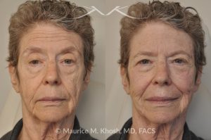 Photo of a patient before and after a procedure. Voluma Filler - before and after photo.