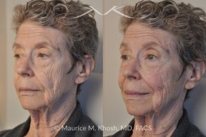 Photo of a patient before and after a procedure. Voluma Filler - before and after photo.